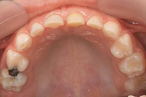 ФОТО: Кариес на жевательных зубах у ребёнка в 6 лет.