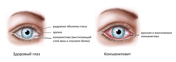 Отличия здорового глаза и больного