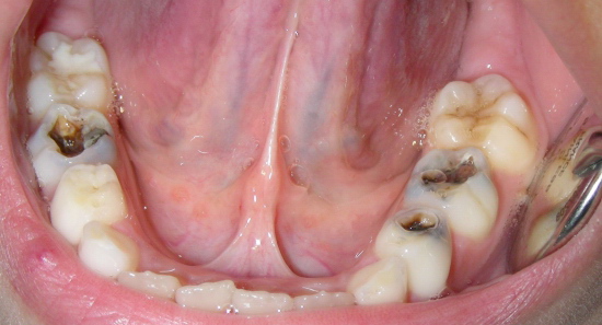 Вид зубов с пульпитом