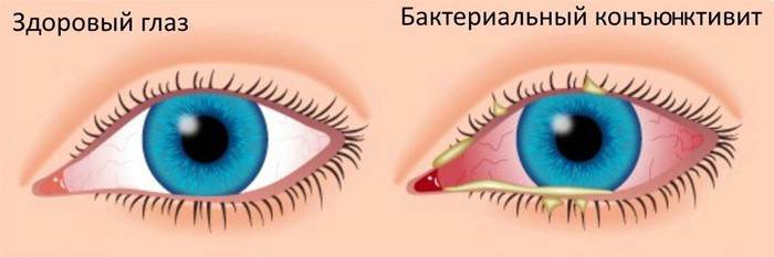 Здоровый глаз и больной бактериальным конъюнктивитом