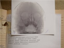 Рентгенография гайморовых пазух