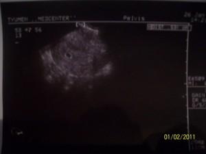УЗИ -5 недель беременности