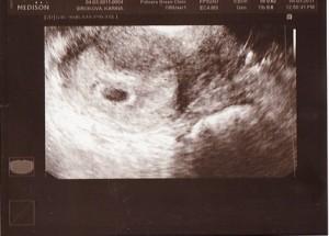 Как выглядит эмбрион в 5 недель