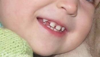 Схема и график прорезывания молочных зубов у детей: отклонения от нормы и их причины