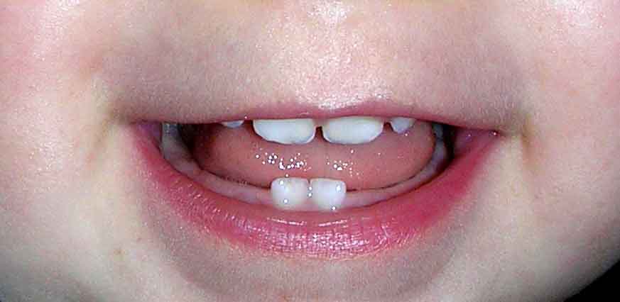молочные зубы Сколько зубов у ребенка
