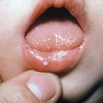 Основные методы лечения молочницы во рту у новорожденных